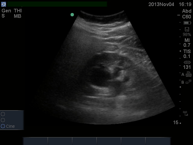 Does this patient have&nbsp;hydronephrosis
