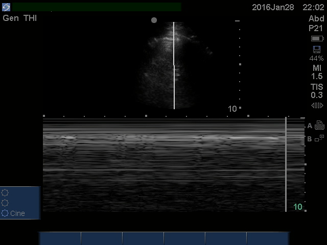 Does this patient have a&nbsp;pneumothorax?
